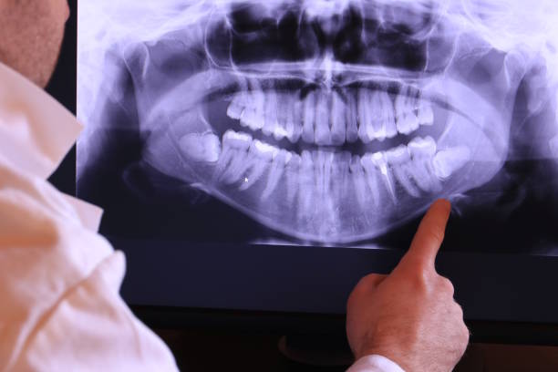 Best Emergency Dental Extractions in Dumont, NJ